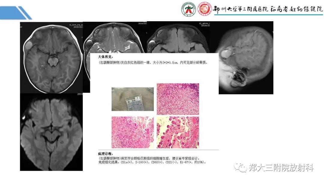 影像PPT - 【PPT】蛛网膜颗粒的影像学表现-25