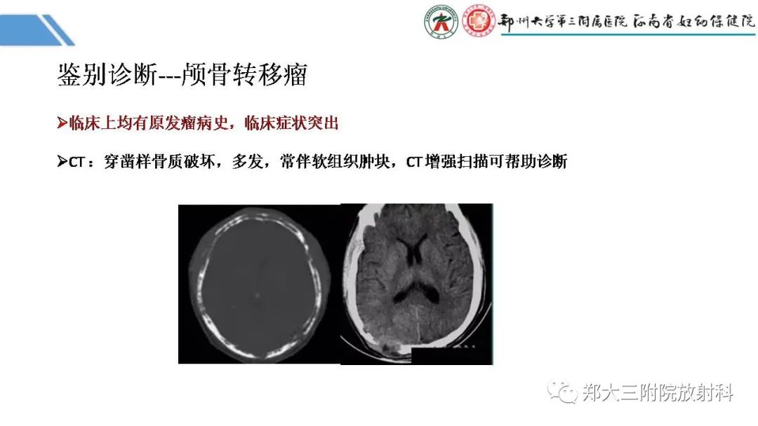 影像PPT - 【PPT】蛛网膜颗粒的影像学表现-27