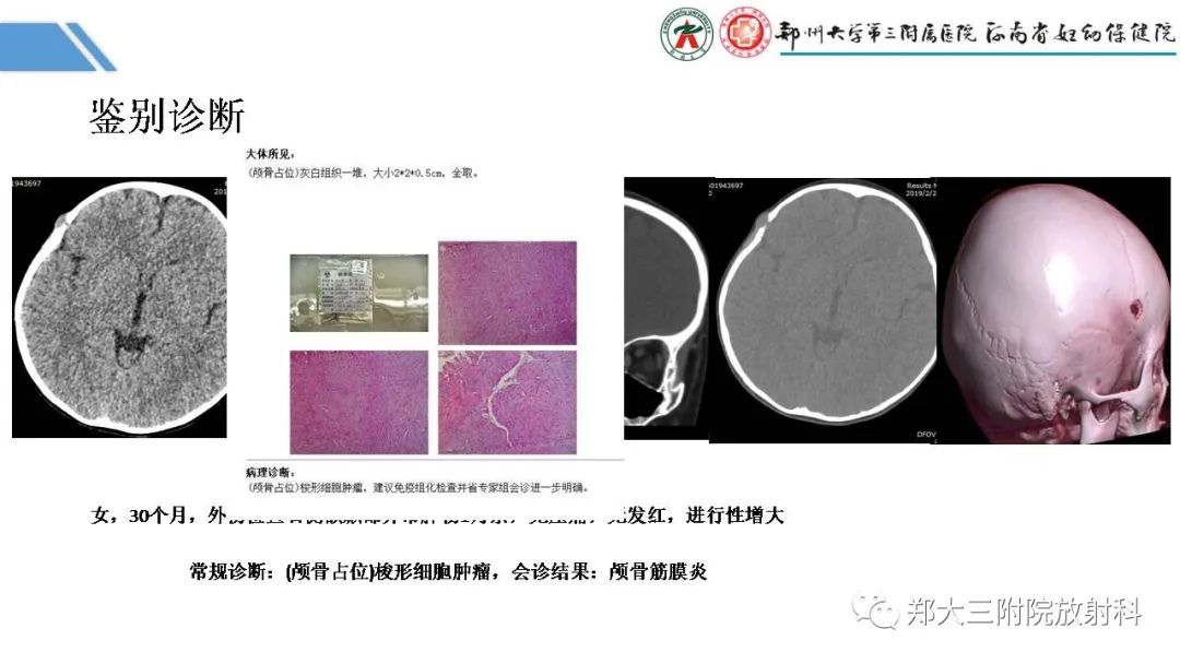 影像PPT - 【PPT】蛛网膜颗粒的影像学表现-30
