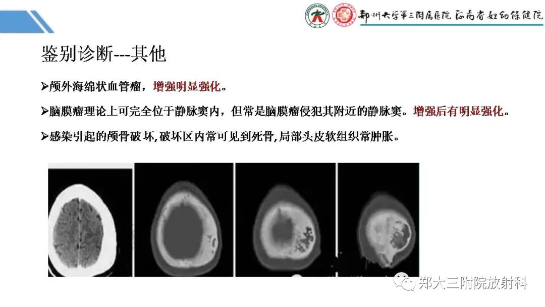 影像PPT - 【PPT】蛛网膜颗粒的影像学表现-29