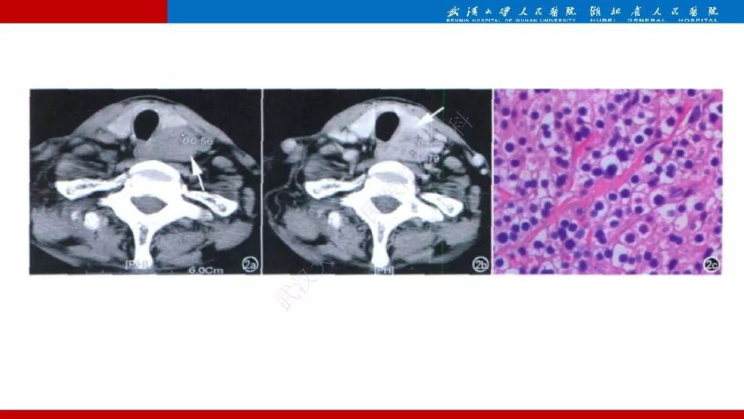 影像PPT - 【PPT】异位甲状旁腺腺瘤的影像诊断-14