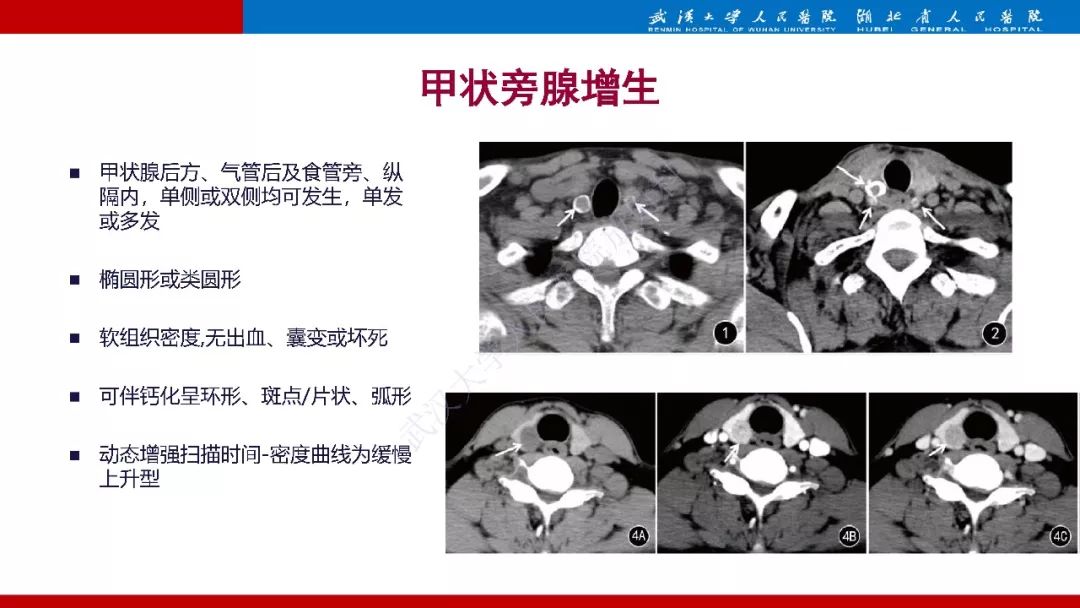 影像PPT - 【PPT】异位甲状旁腺腺瘤的影像诊断-18
