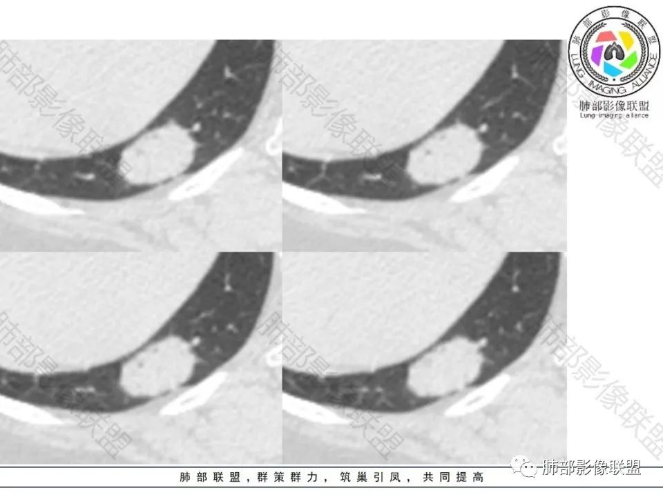 影像PPT - 【病例】不那么陌生的MALT-8 影像PPT - 【病例】不那么陌生的MALT-8