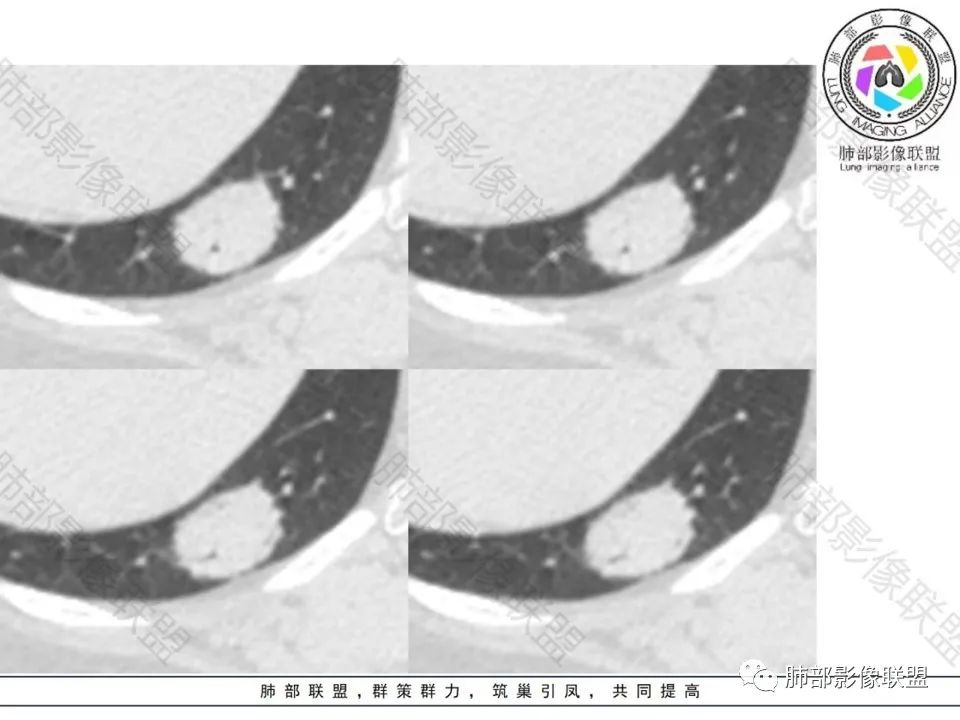 影像PPT - 【病例】不那么陌生的MALT-7 影像PPT - 【病例】不那么陌生的MALT-7