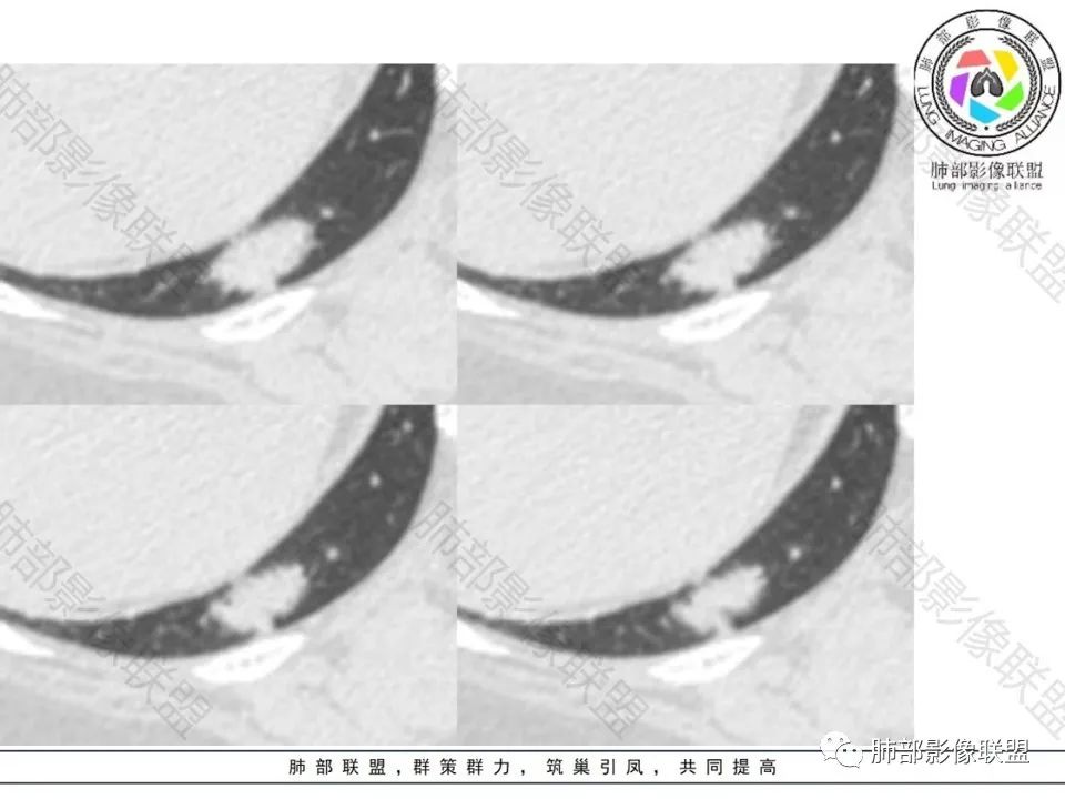 影像PPT - 【病例】不那么陌生的MALT-10 影像PPT - 【病例】不那么陌生的MALT-10