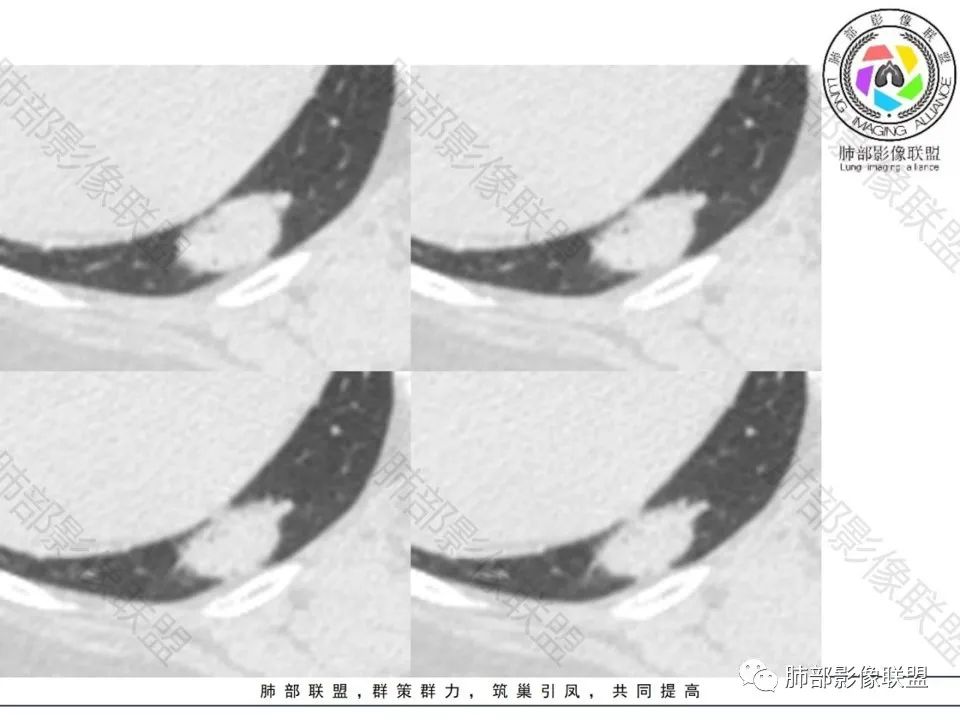 影像PPT - 【病例】不那么陌生的MALT-9 影像PPT - 【病例】不那么陌生的MALT-9