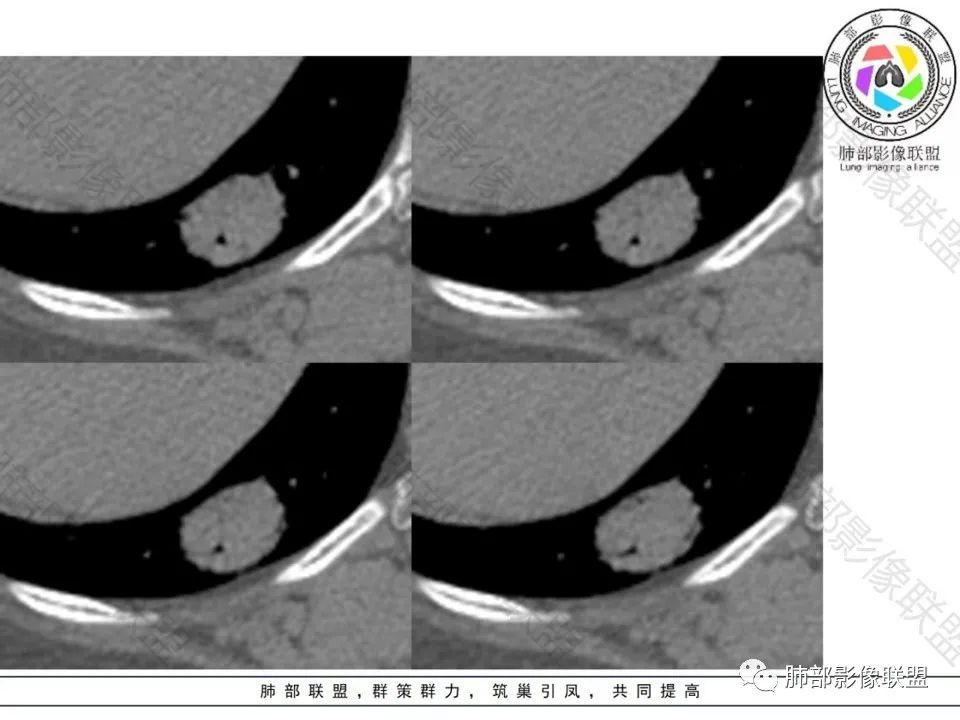 影像PPT - 【病例】不那么陌生的MALT-14 影像PPT - 【病例】不那么陌生的MALT-14