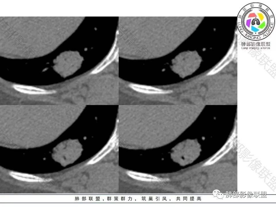影像PPT - 【病例】不那么陌生的MALT-13 影像PPT - 【病例】不那么陌生的MALT-13