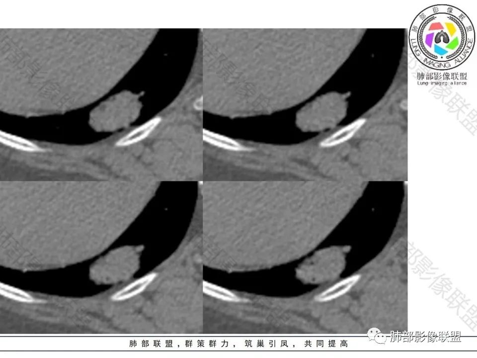 影像PPT - 【病例】不那么陌生的MALT-15 影像PPT - 【病例】不那么陌生的MALT-15