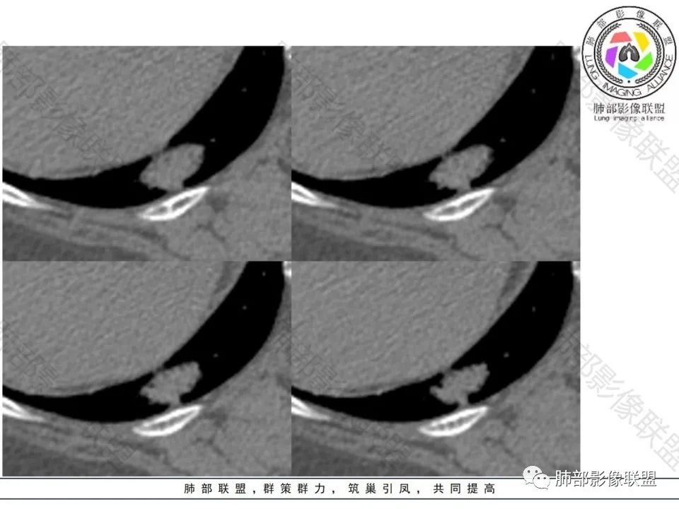 影像PPT - 【病例】不那么陌生的MALT-16 影像PPT - 【病例】不那么陌生的MALT-16
