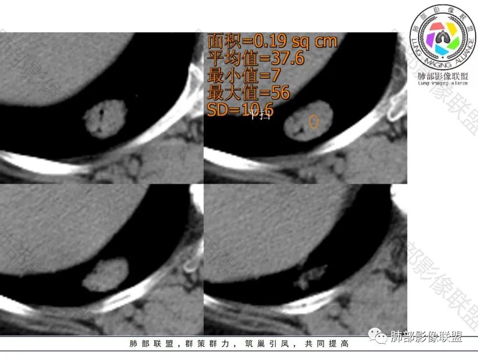 影像PPT - 【病例】不那么陌生的MALT-17 影像PPT - 【病例】不那么陌生的MALT-17
