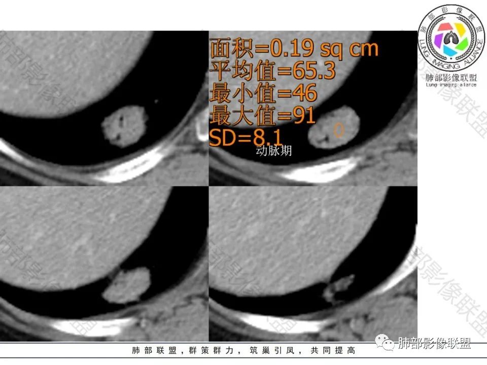 影像PPT - 【病例】不那么陌生的MALT-18 影像PPT - 【病例】不那么陌生的MALT-18