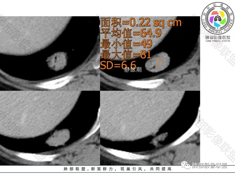 影像PPT - 【病例】不那么陌生的MALT-19 影像PPT - 【病例】不那么陌生的MALT-19