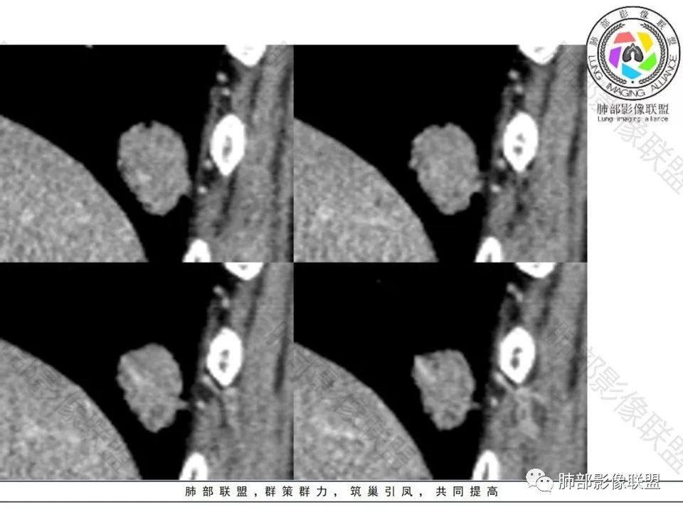 影像PPT - 【病例】不那么陌生的MALT-23 影像PPT - 【病例】不那么陌生的MALT-23