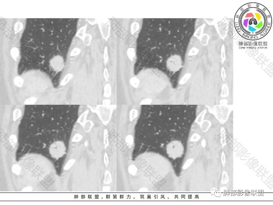 影像PPT - 【病例】不那么陌生的MALT-24 影像PPT - 【病例】不那么陌生的MALT-24