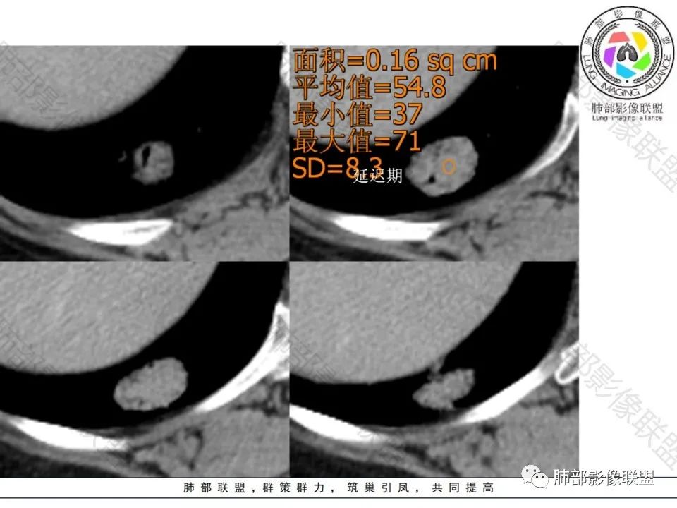影像PPT - 【病例】不那么陌生的MALT-20 影像PPT - 【病例】不那么陌生的MALT-20