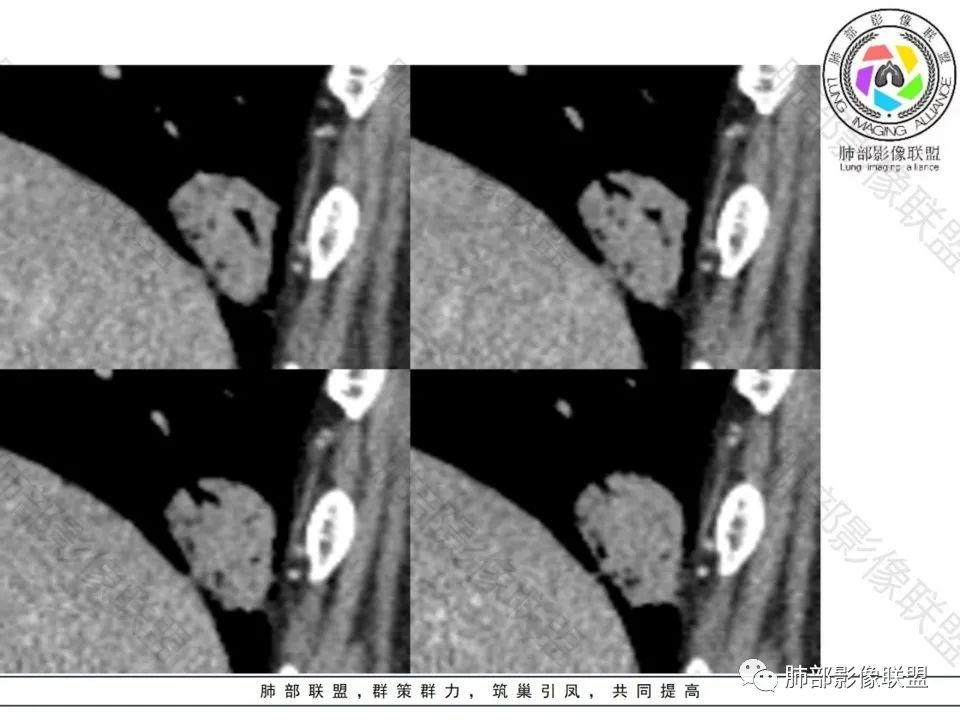 影像PPT - 【病例】不那么陌生的MALT-22 影像PPT - 【病例】不那么陌生的MALT-22