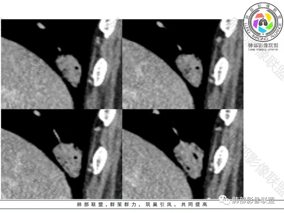 影像PPT - 【病例】不那么陌生的MALT-21 影像PPT - 【病例】不那么陌生的MALT-21