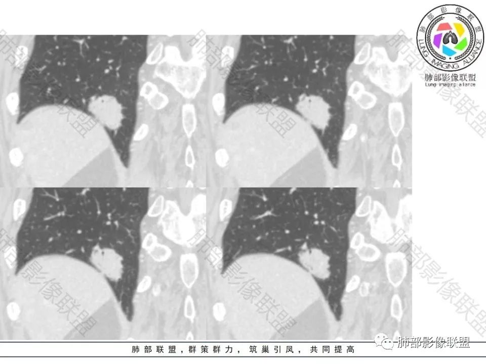 影像PPT - 【病例】不那么陌生的MALT-26 影像PPT - 【病例】不那么陌生的MALT-26