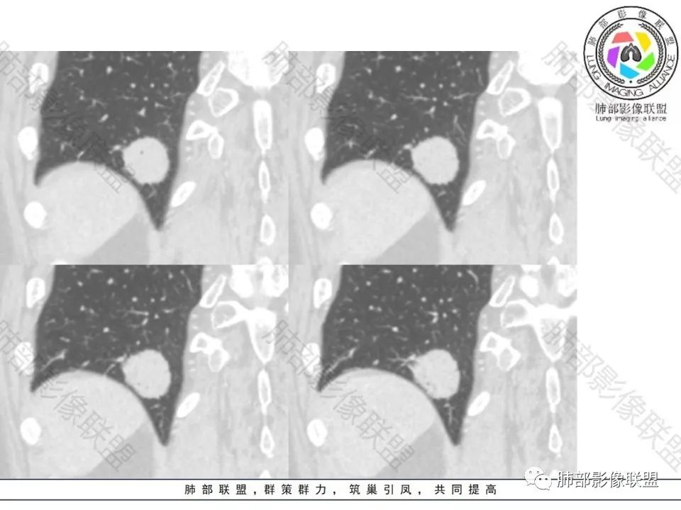 影像PPT - 【病例】不那么陌生的MALT-25 影像PPT - 【病例】不那么陌生的MALT-25