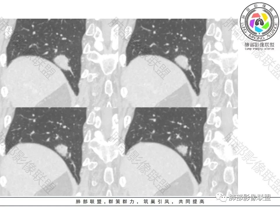 影像PPT - 【病例】不那么陌生的MALT-27 影像PPT - 【病例】不那么陌生的MALT-27