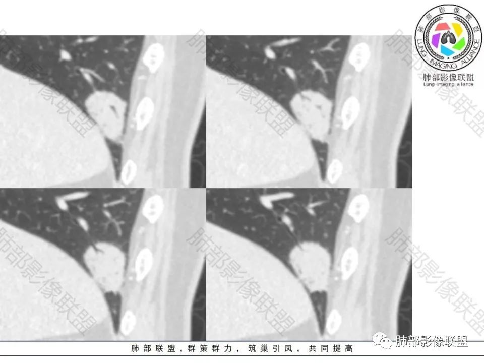 影像PPT - 【病例】不那么陌生的MALT-28 影像PPT - 【病例】不那么陌生的MALT-28