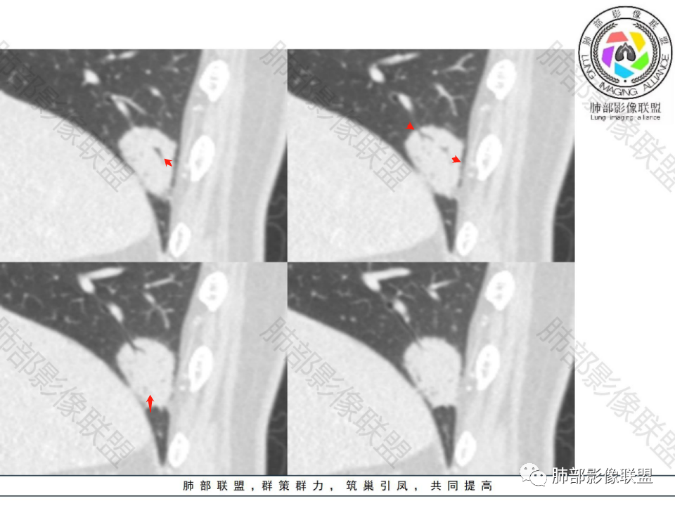 影像PPT - 【病例】不那么陌生的MALT-31 影像PPT - 【病例】不那么陌生的MALT-31