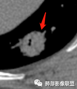 影像PPT - 【病例】不那么陌生的MALT-33 影像PPT - 【病例】不那么陌生的MALT-33