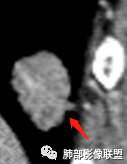 影像PPT - 【病例】不那么陌生的MALT-34 影像PPT - 【病例】不那么陌生的MALT-34