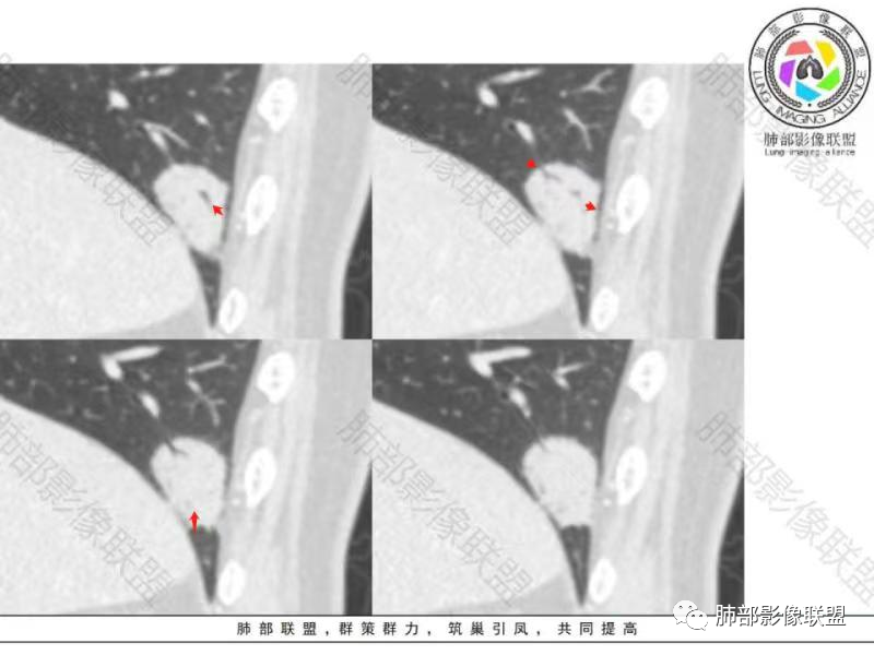 影像PPT - 【病例】不那么陌生的MALT-37 影像PPT - 【病例】不那么陌生的MALT-37