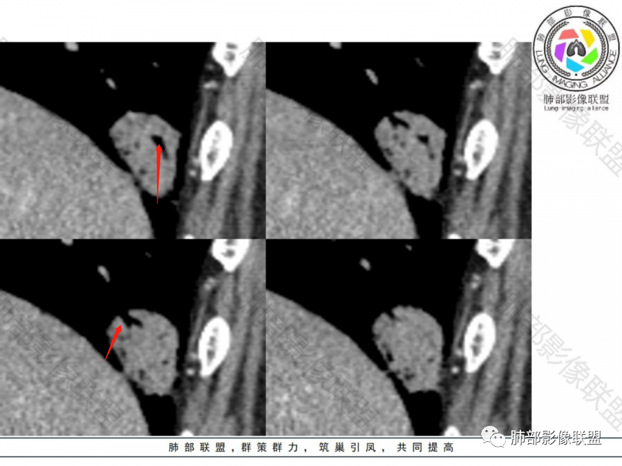 影像PPT - 【病例】不那么陌生的MALT-39 影像PPT - 【病例】不那么陌生的MALT-39