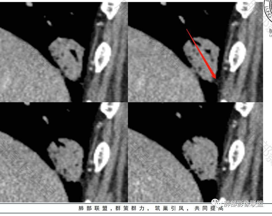 影像PPT - 【病例】不那么陌生的MALT-40 影像PPT - 【病例】不那么陌生的MALT-40