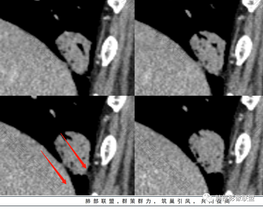 影像PPT - 【病例】不那么陌生的MALT-41 影像PPT - 【病例】不那么陌生的MALT-41