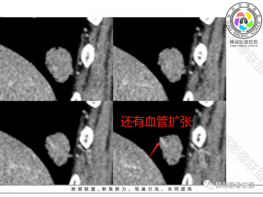 影像PPT - 【病例】不那么陌生的MALT-42 影像PPT - 【病例】不那么陌生的MALT-42