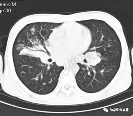 影像PPT - 【病例】不那么陌生的MALT-48 影像PPT - 【病例】不那么陌生的MALT-48