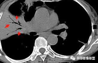 影像PPT - 【病例】不那么陌生的MALT-52 影像PPT - 【病例】不那么陌生的MALT-52