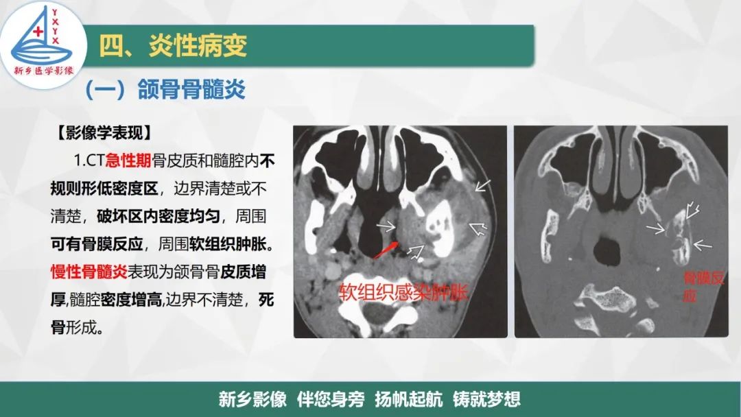 影像PPT - 【PPT】医学影像诊断学教材解读—口腔颌面部疾病-11