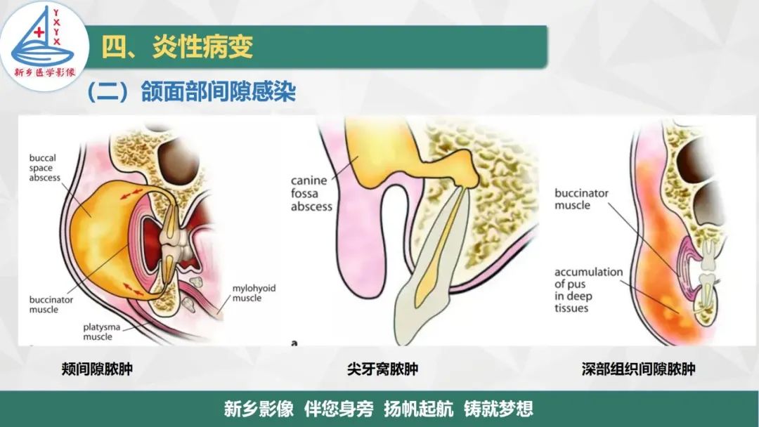 影像PPT - 【PPT】医学影像诊断学教材解读—口腔颌面部疾病-14