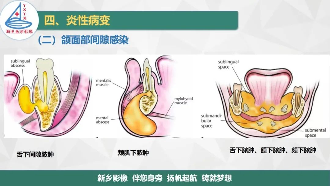 影像PPT - 【PPT】医学影像诊断学教材解读—口腔颌面部疾病-15