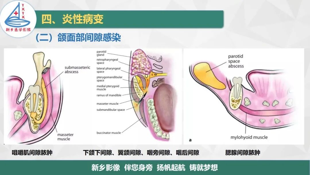影像PPT - 【PPT】医学影像诊断学教材解读—口腔颌面部疾病-17