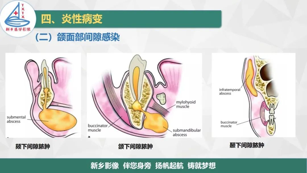 影像PPT - 【PPT】医学影像诊断学教材解读—口腔颌面部疾病-16