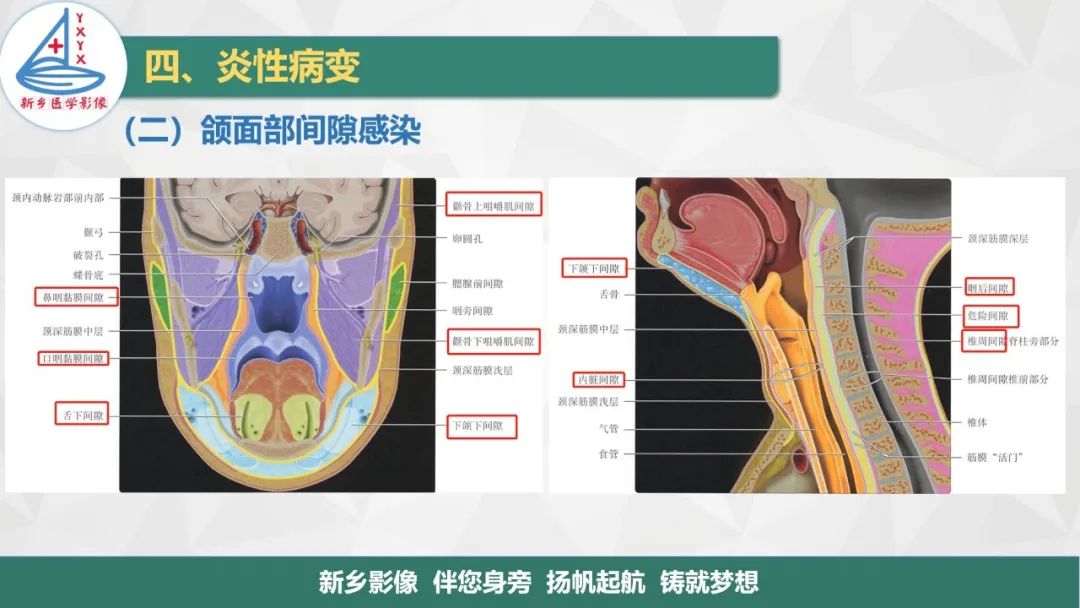 影像PPT - 【PPT】医学影像诊断学教材解读—口腔颌面部疾病-20