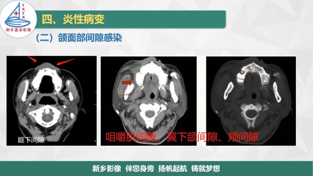 影像PPT - 【PPT】医学影像诊断学教材解读—口腔颌面部疾病-22