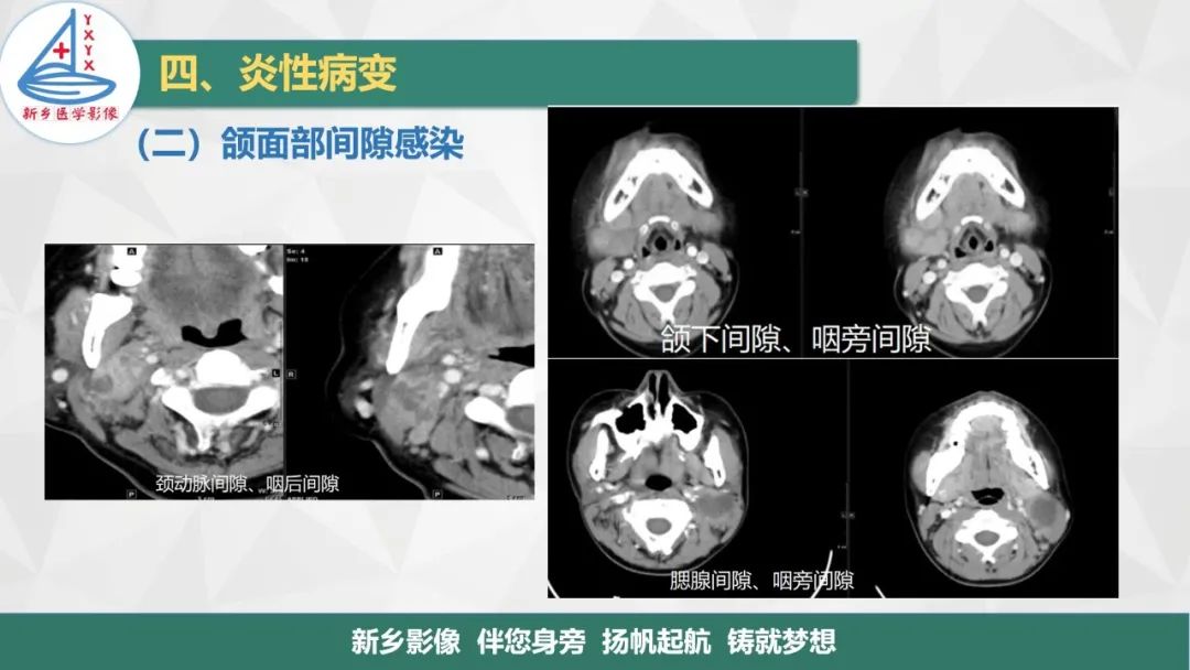 影像PPT - 【PPT】医学影像诊断学教材解读—口腔颌面部疾病-23