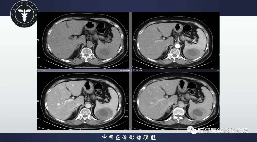 影像PPT - 【病例】脾脏窦岸细胞血管瘤1例CT影像-4 影像PPT - 【病例】脾脏窦岸细胞血管瘤1例CT影像-4