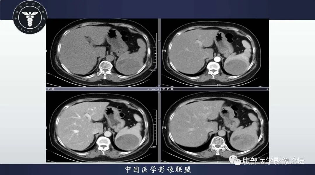 影像PPT - 【病例】脾脏窦岸细胞血管瘤1例CT影像-6 影像PPT - 【病例】脾脏窦岸细胞血管瘤1例CT影像-6