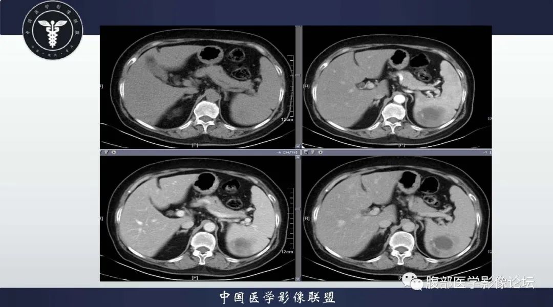 影像PPT - 【病例】脾脏窦岸细胞血管瘤1例CT影像-3 影像PPT - 【病例】脾脏窦岸细胞血管瘤1例CT影像-3
