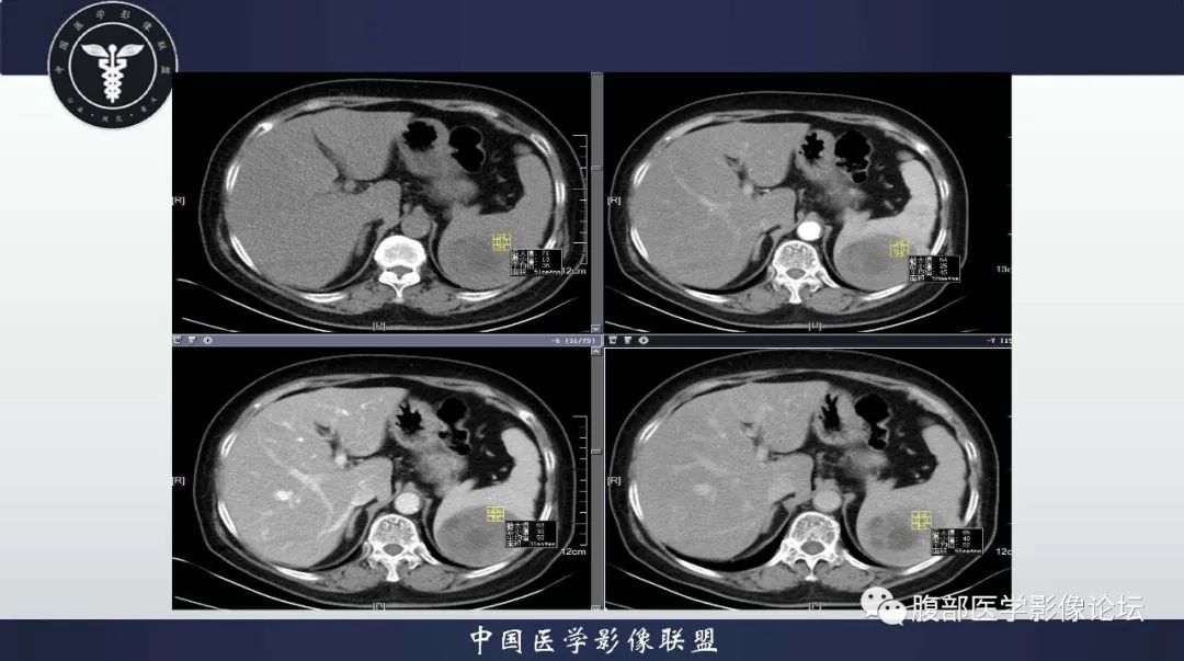 影像PPT - 【病例】脾脏窦岸细胞血管瘤1例CT影像-5 影像PPT - 【病例】脾脏窦岸细胞血管瘤1例CT影像-5