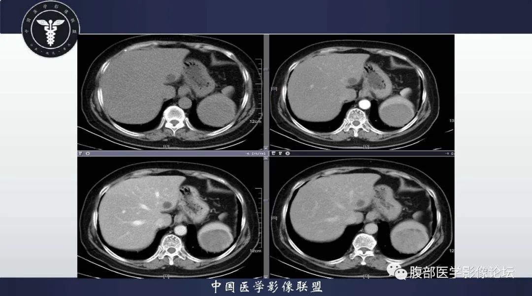 影像PPT - 【病例】脾脏窦岸细胞血管瘤1例CT影像-8 影像PPT - 【病例】脾脏窦岸细胞血管瘤1例CT影像-8