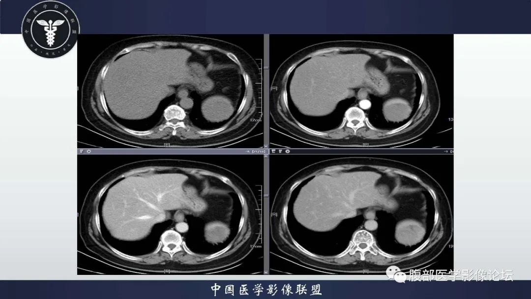 影像PPT - 【病例】脾脏窦岸细胞血管瘤1例CT影像-9 影像PPT - 【病例】脾脏窦岸细胞血管瘤1例CT影像-9